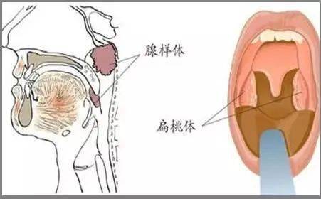 为什么孩子会有腺样体肥大,并带来这么多危险呢?