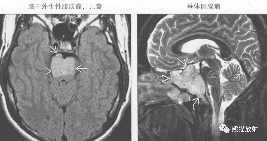 鉴别诊断丨桥前池肿块