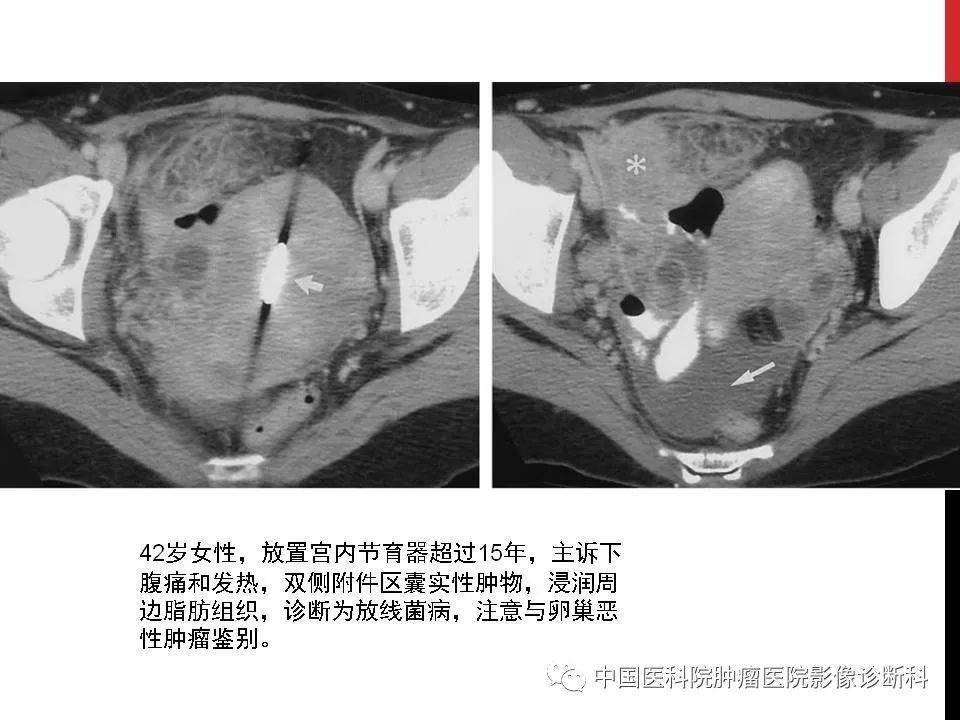 观察盆腔积液情况,了解怀孕情况及孕囊位置·ct是必要补充(观察范围