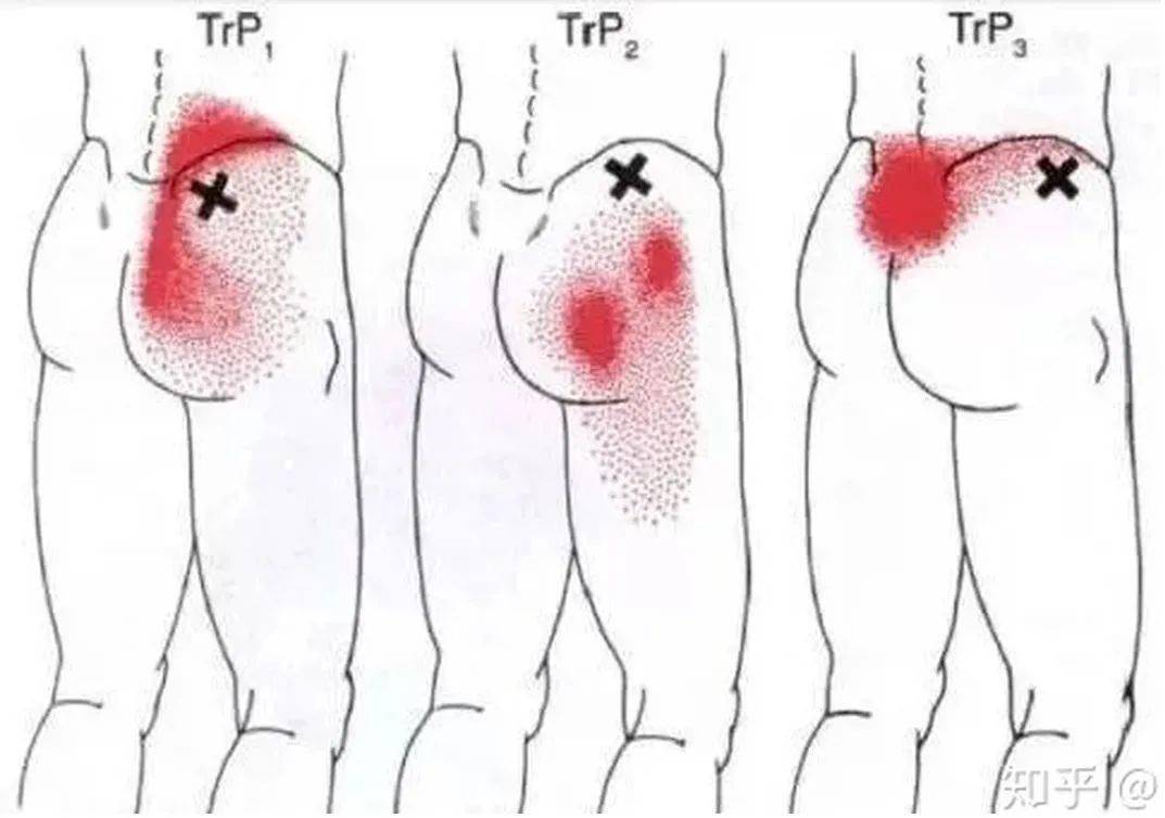 【产后康复】月子里腰腿痛,屁股疼,究竟哪里闯了祸?