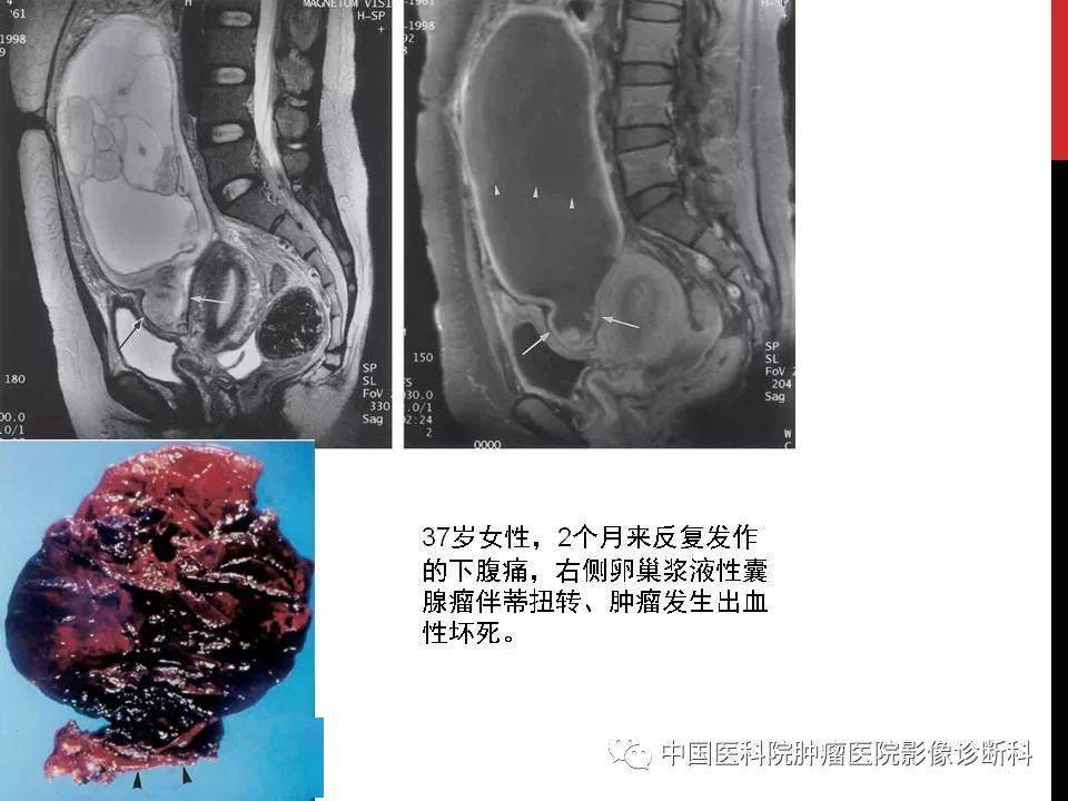 简便,快捷(异位妊娠破裂出血,卵巢黄体囊肿破裂出血,观察盆腔积液情况