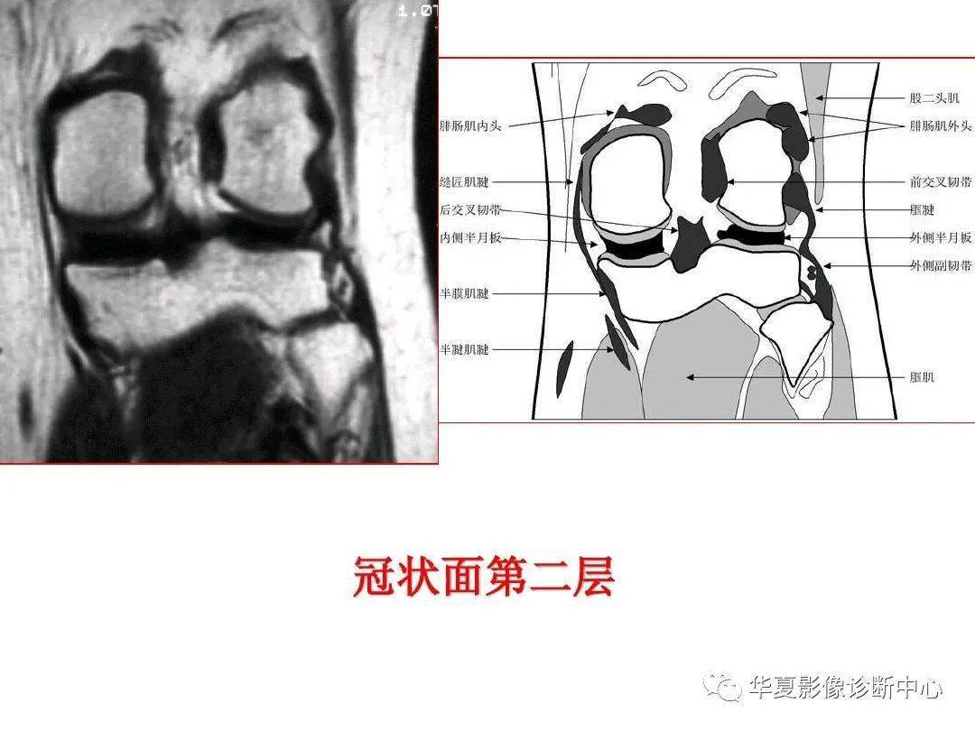 交叉韧带解剖及损伤的mri诊断