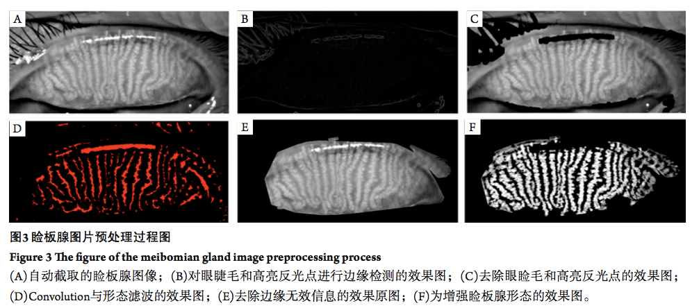 基于红外成像原理的睑板腺图像量化分析系统眼科学报杂志文章精选