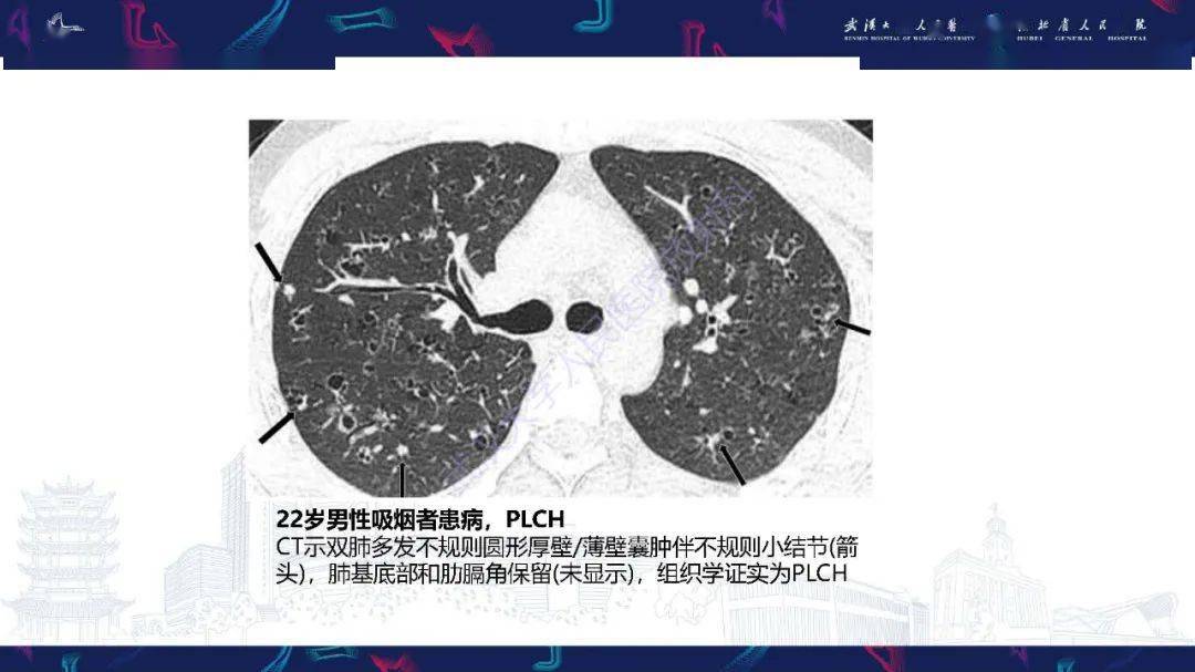 肺部囊性病变影像诊断