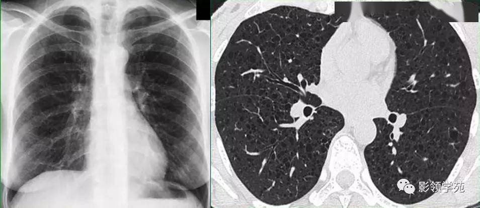 11种肺部囊腔病变的ct表现