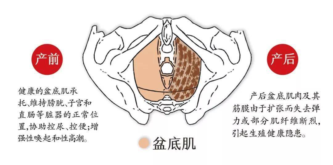 盆底肌:一胎不修复,二胎徒伤悲!