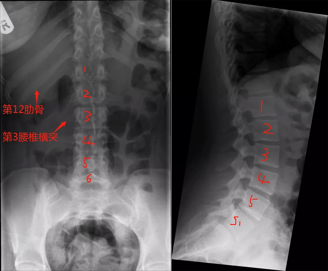 腰骶骨移行椎你是如何判断的