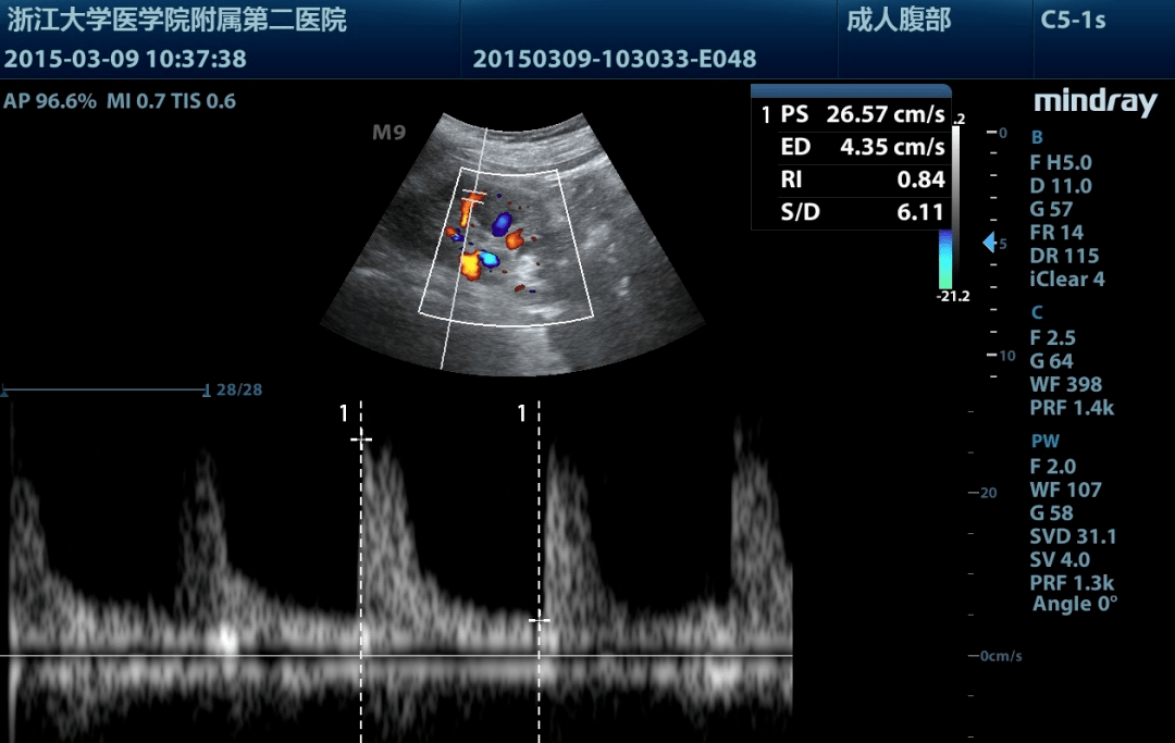 零基础入门「肾脏超声」,掌握切面与测量就够了!