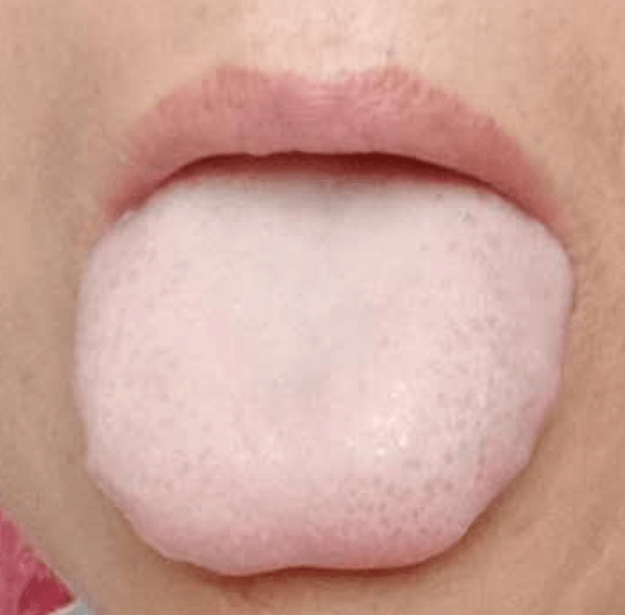 此类舌苔的白就是血虚导致的白对于该汤剂,有一点是需要注意的:1,如果