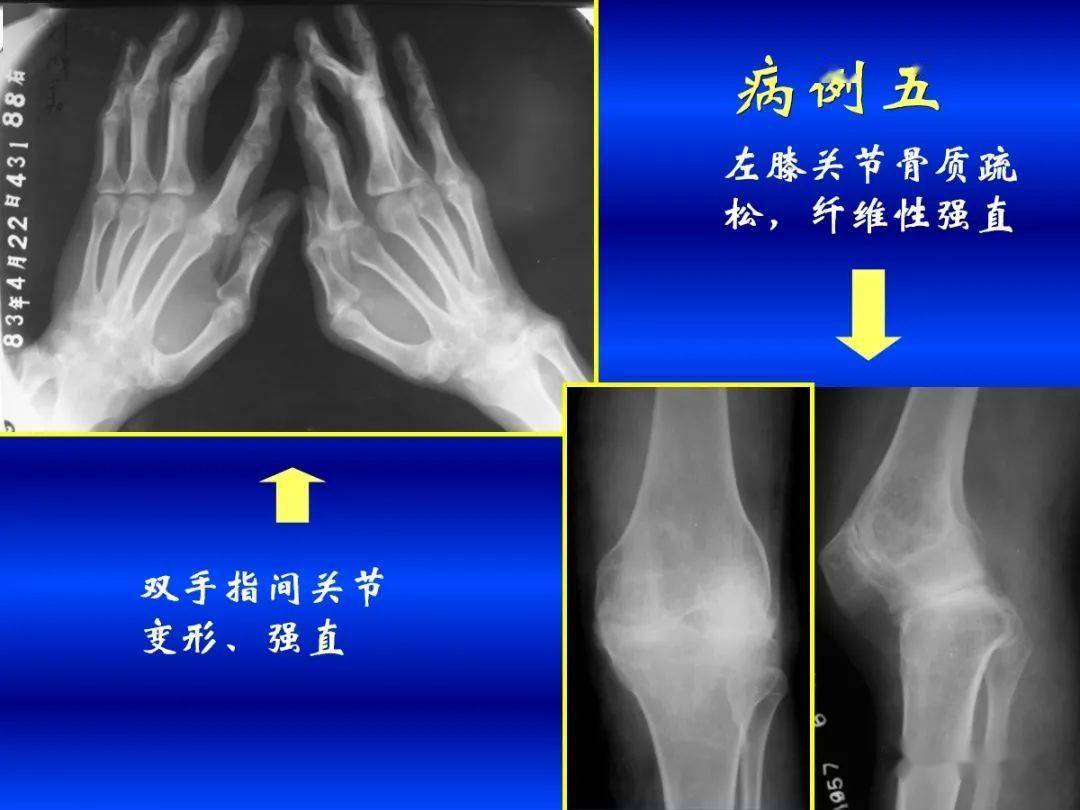 超全!各种关节炎的影像学表现