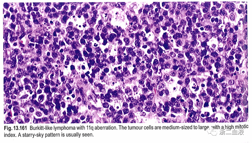 burkitt淋巴瘤的病理诊断