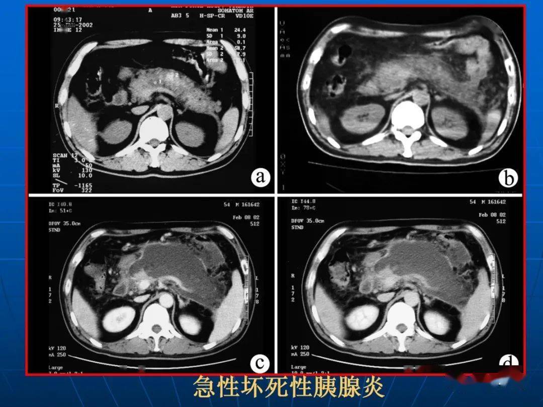 9种胰腺常见疾病的ct诊断