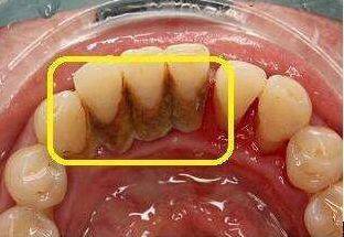牙结石的3大危害