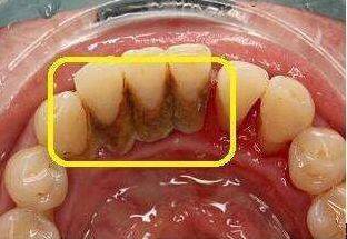 牙齿缝里,抠出黄色物质到底是什么?为啥那么臭