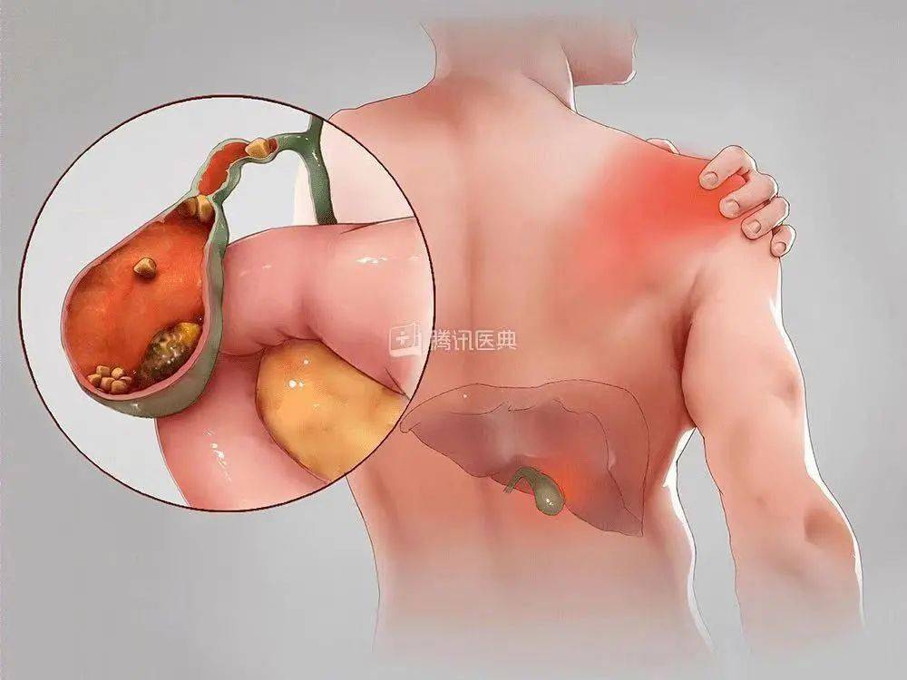 图片来源:腾讯医典 0 1 女性多发 胆结石的发病率, 女性比男性多 2.