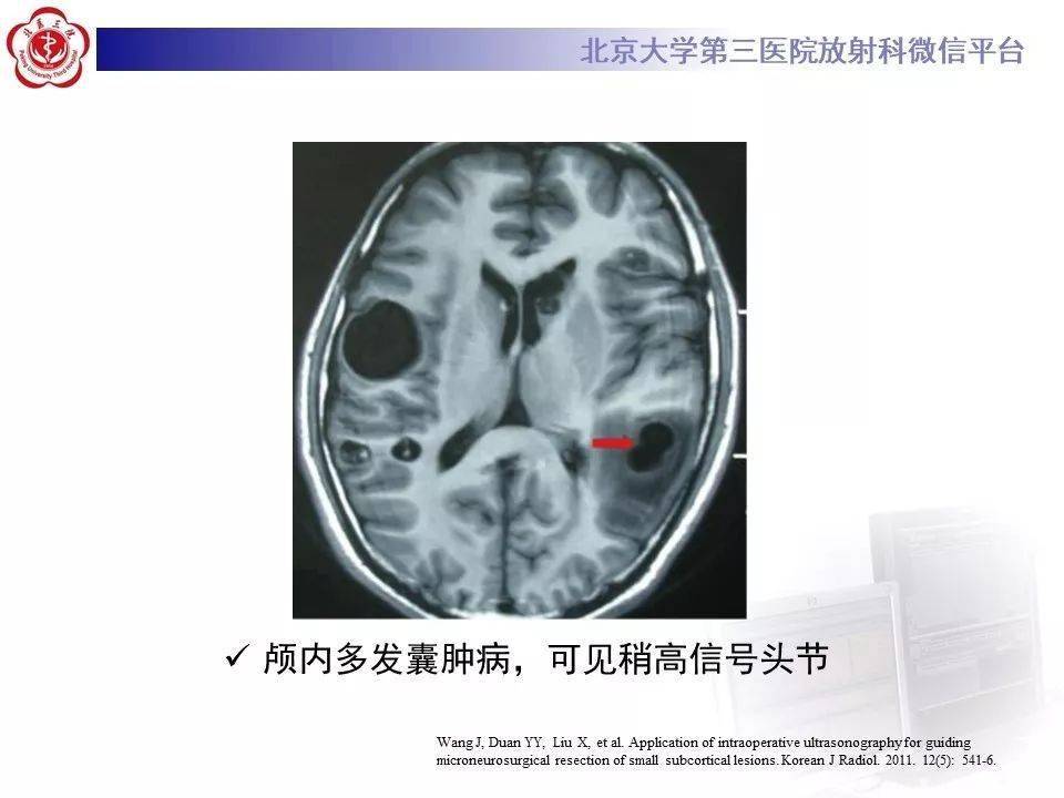 神经上皮囊肿影像表现