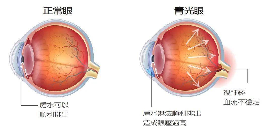 眼压高的症状有哪些?