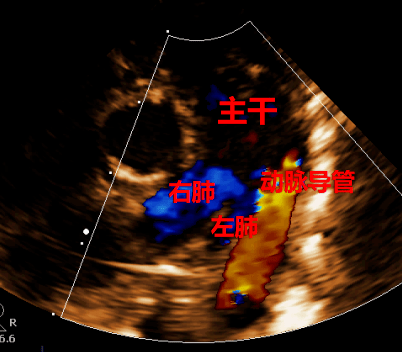 从典型病例学习应用超声心动图诊断动脉导管未闭