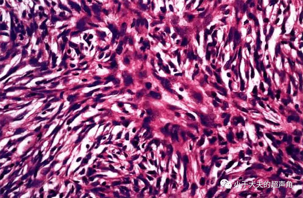 显微镜下,隆突性皮肤纤维肉瘤的特征表现为:①大量的梭形细胞  呈