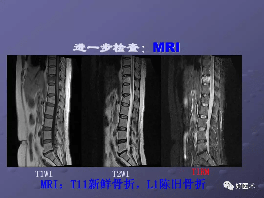 详解脊柱常见疾病的mri诊断技巧值得学习借鉴