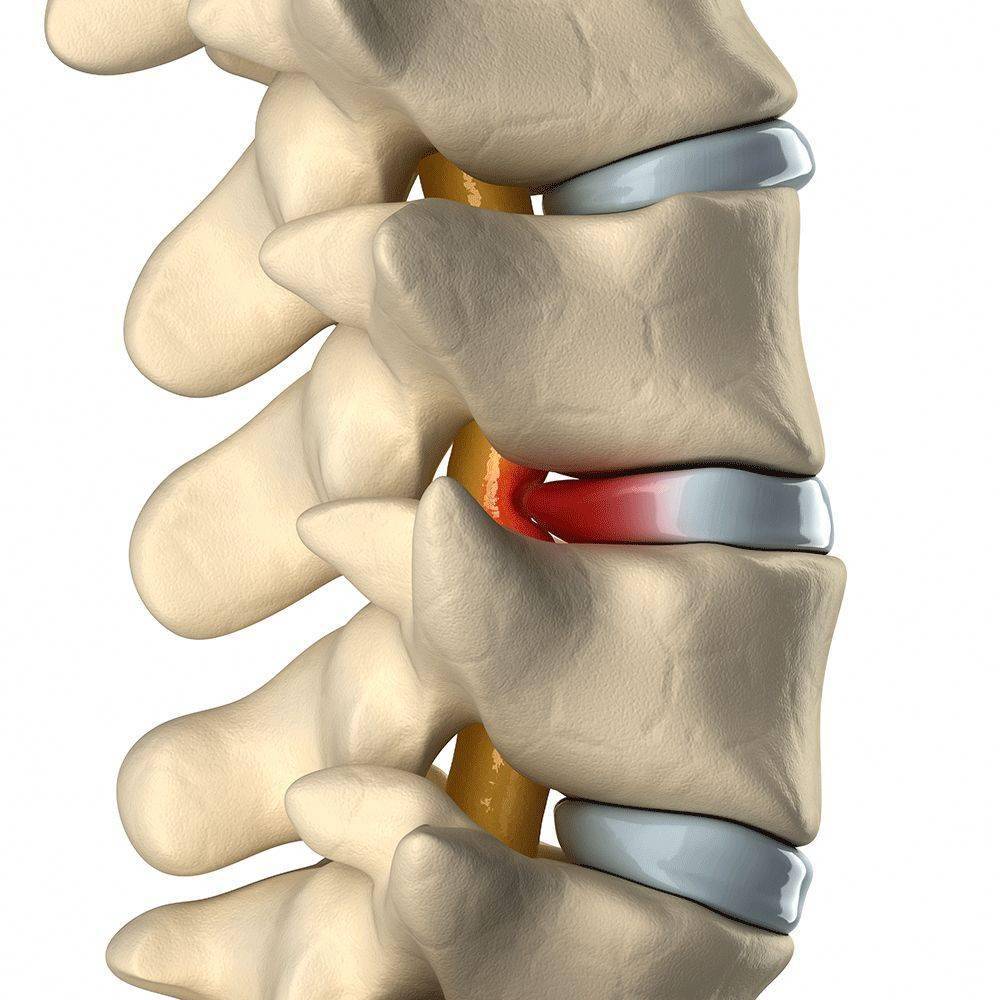 腰椎间盘突出多发生于第   和第   腰椎