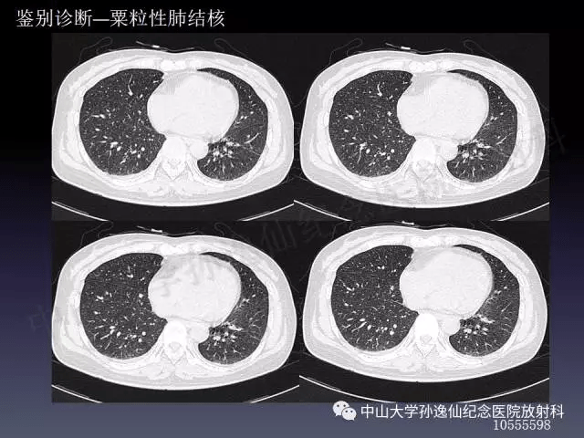 肺出血的影像学特征