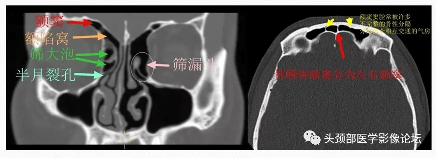 影像解剖额筛气房与钩突附着部精细解剖