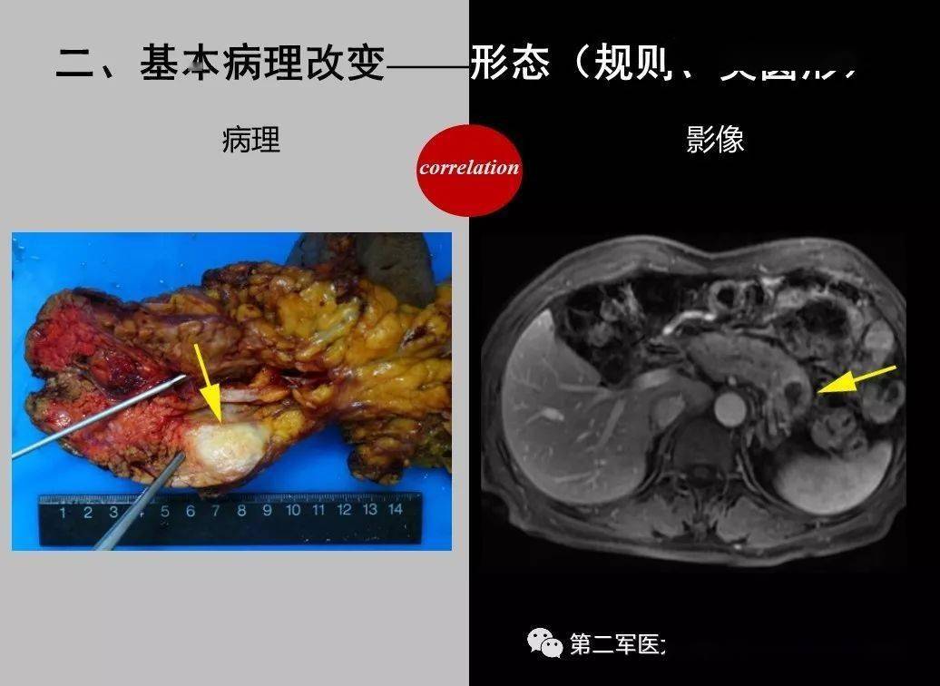 胰腺基本病变的影像表现汇总