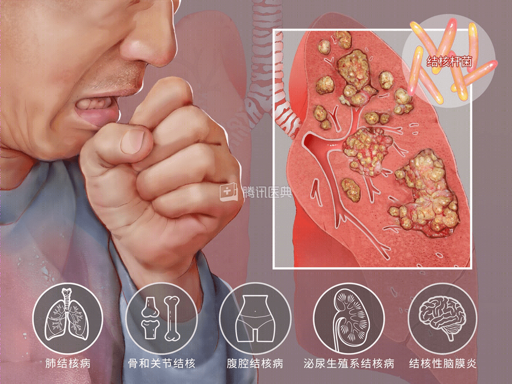 什么是肺结核如何预防