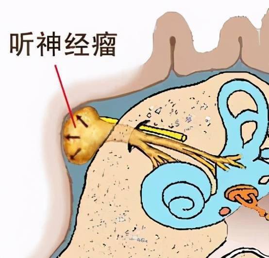 荆州市中心医院:耳鸣也能扯上肿瘤?万万不可掉以轻心