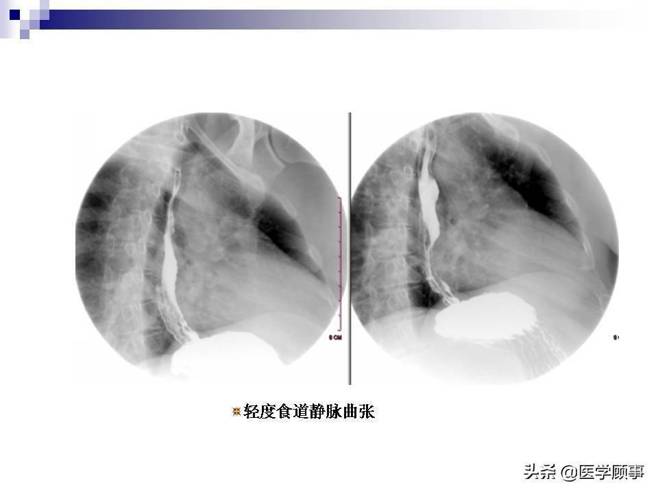 食道癌科普及影像分析