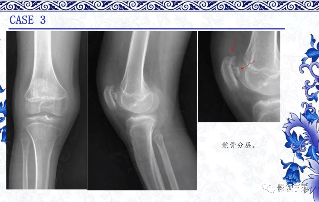 7种常见的骨软骨发育异常x线表现