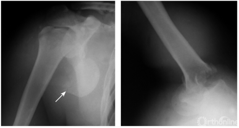 骨科常见疾病x线解析之肩关节骨折与脱位