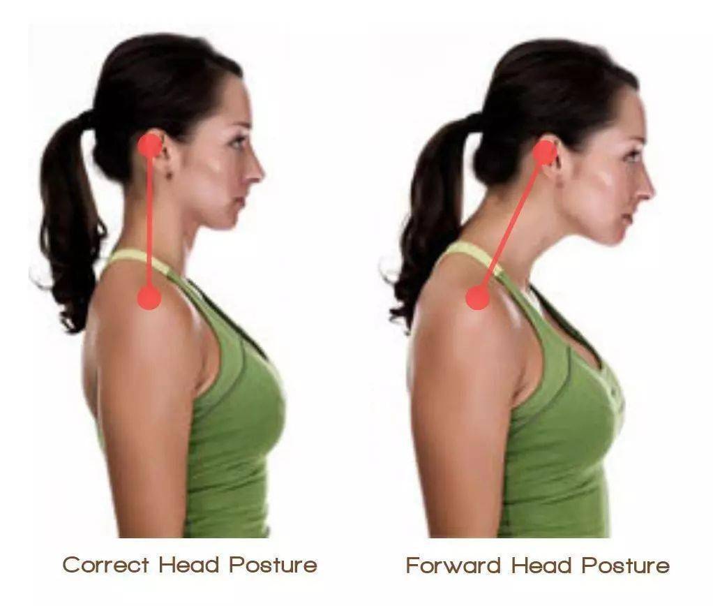 这种驼背,在医学上有个术语叫做颈前屈或颈椎生理曲度变直:  由于长期