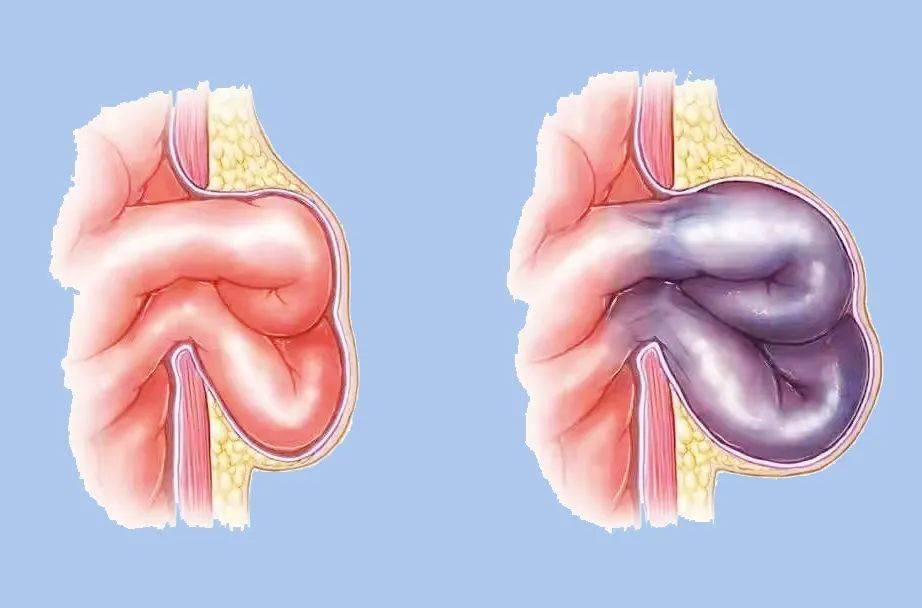 因此新生儿嵌顿疝原则上应紧急手术治疗,解除肠梗阻,以防疝内容物坏死
