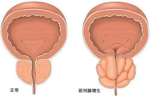 ——前列腺增生手术的金标准