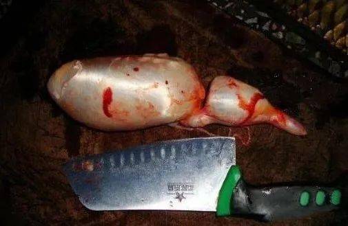 急诊科医生检查发现,该男子已经出现了严重的肝肾功能损害