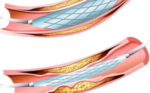 e药房 权威专家解答关于冠脉支架的六大疑问!_心血管