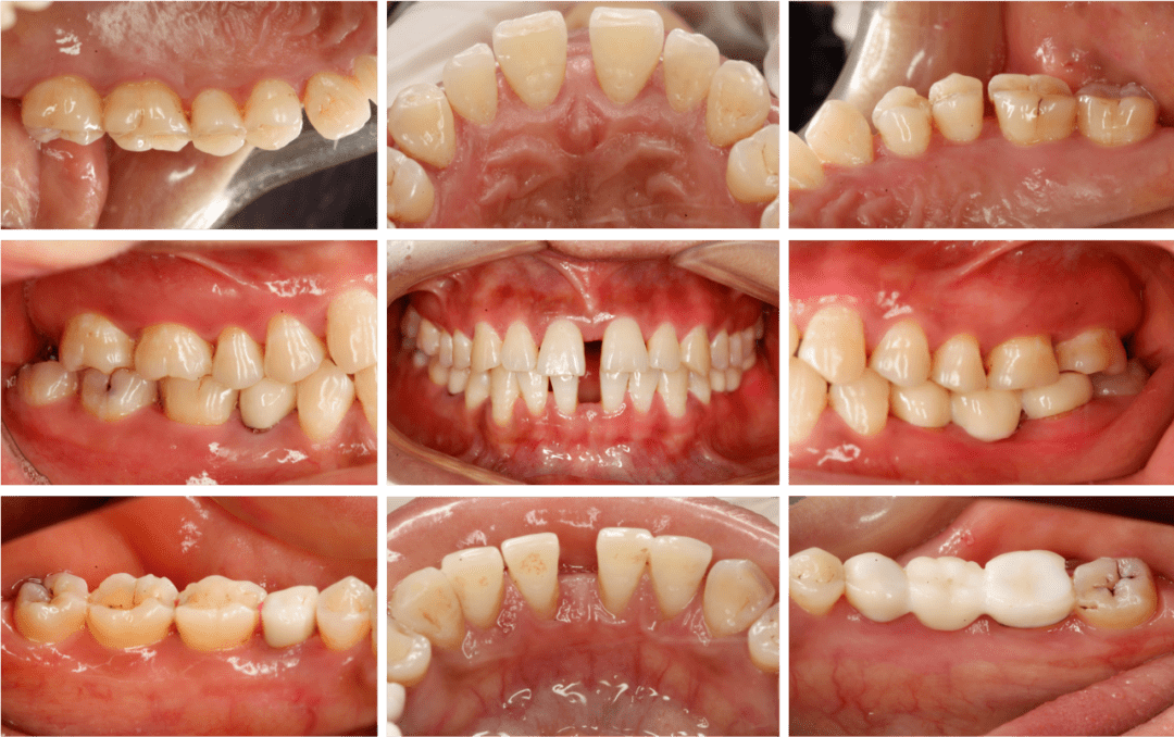 慢性牙周炎患者牙周序列治疗联合修复治疗1例