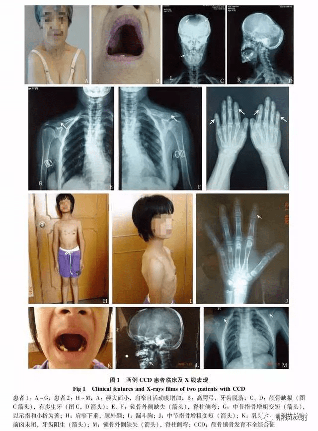 x线诊断要点丨骨与关节发育畸形上肢