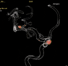 支架辅助弹簧圈栓塞右侧颈内动脉多发动脉瘤