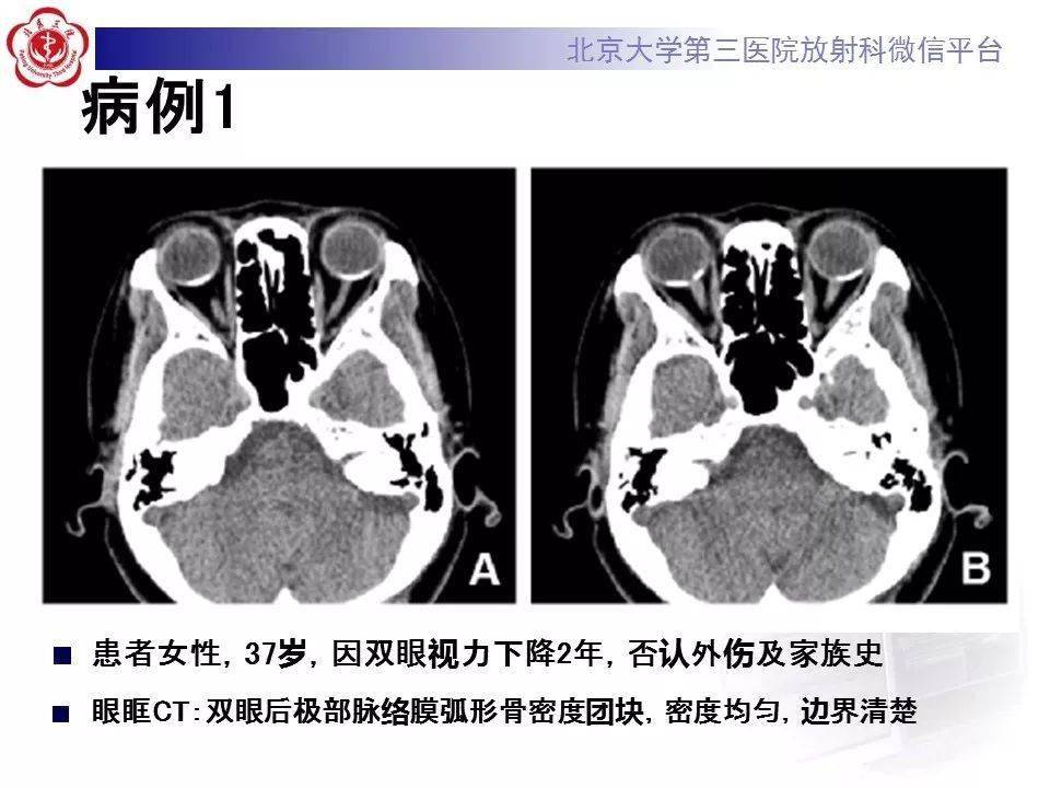 一看就会!脉络膜骨瘤影像表现