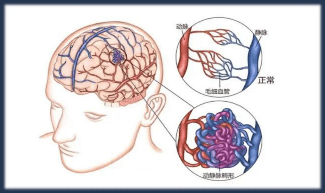 脑血管畸形有很多种类型,其中以动静脉畸形最为多见,那么,什么是动