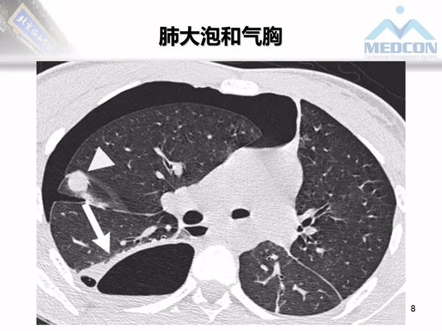 肺气肿基础学习及拓展