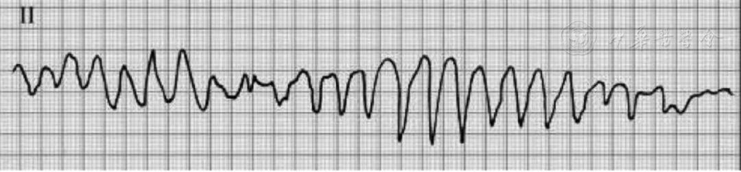 s,或虽然 30 s,但伴血液动力学不稳定的室性 (6)心室颤动的波形,振幅