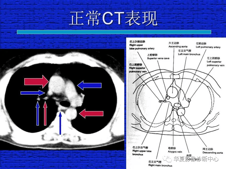 ct入门结合解剖谈正常胸部ct读片