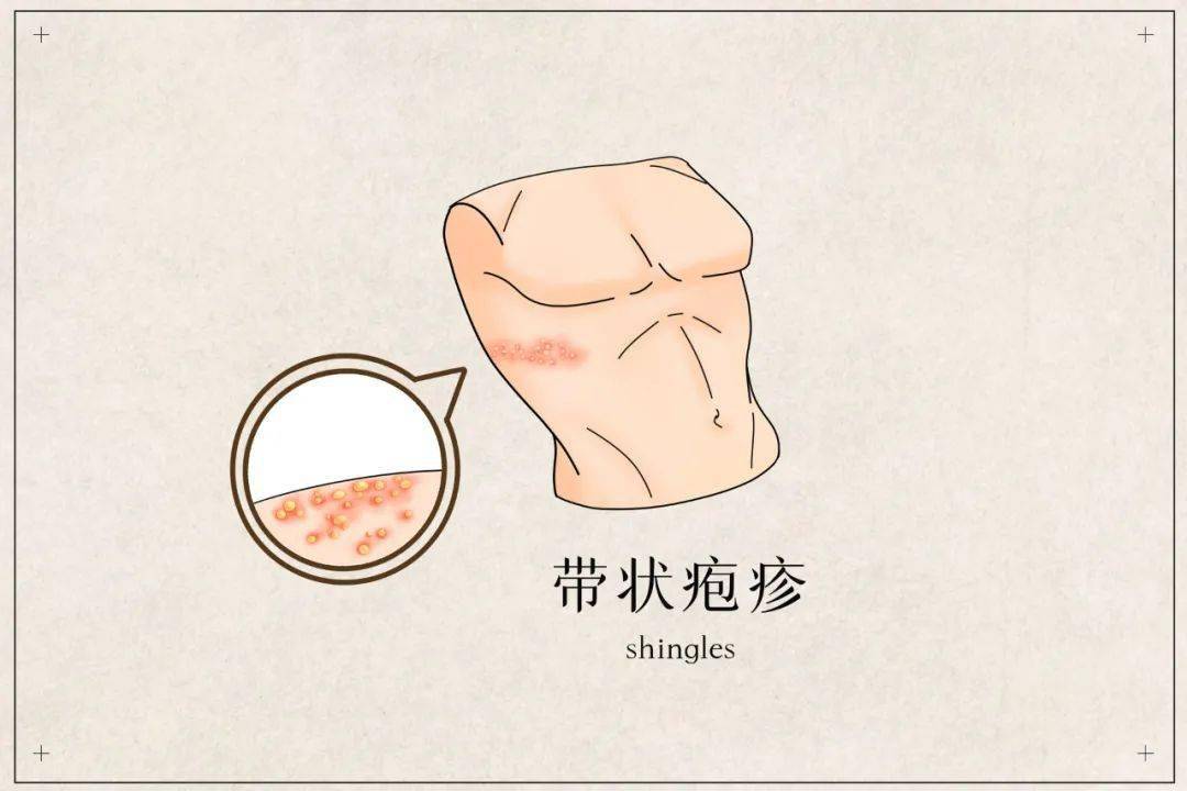 远离"蛇缠腰",带状疱疹可防可治!