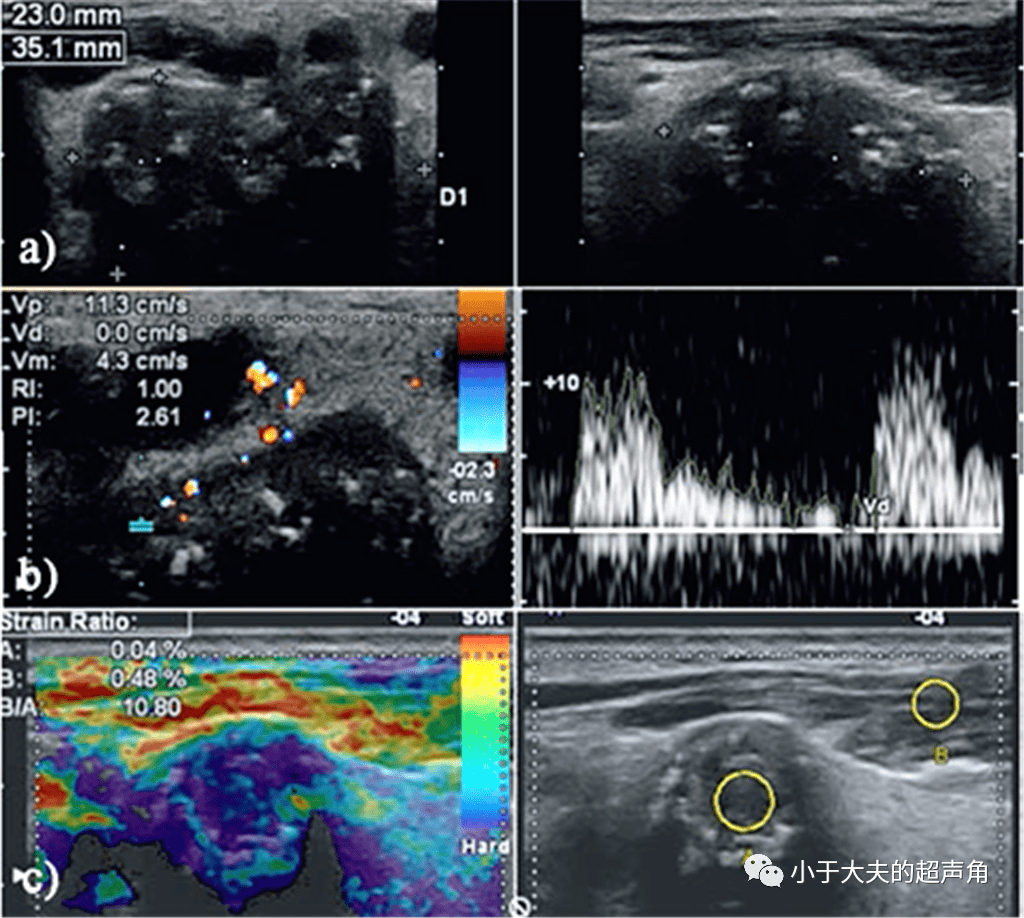 右侧腮腺恶性肿瘤局部浸润,伴同侧颈部淋巴结转移超声诊断:此外,超声