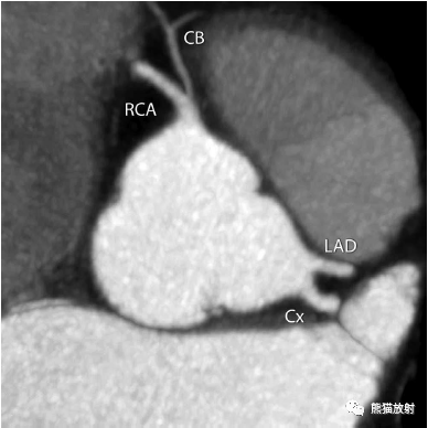 冠状动脉ct:相关概念,解剖