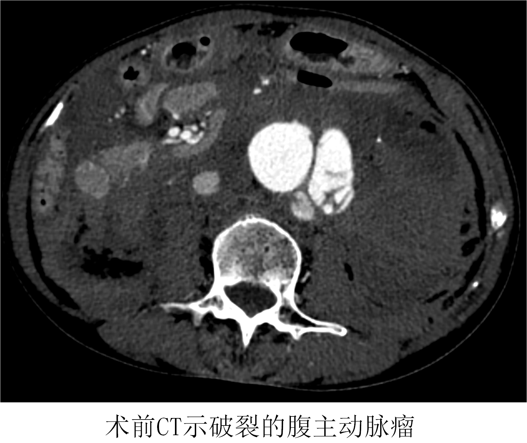 仁济医院采用腔内技术成功救治一例危重腹主动脉瘤破裂患者